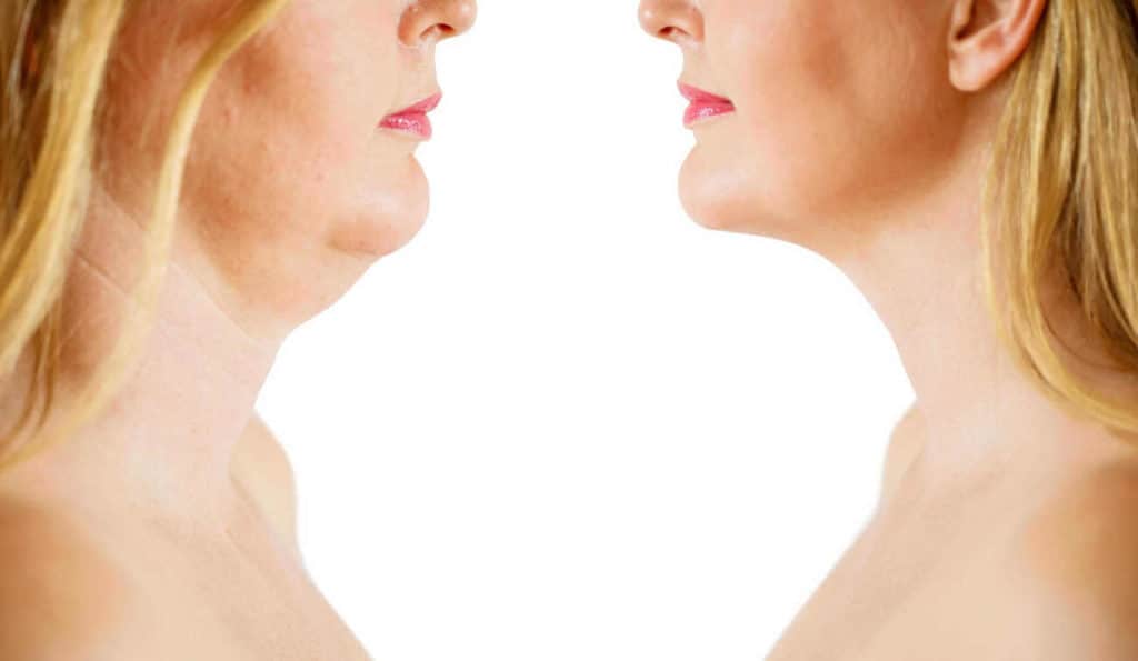 Double Chin treatment East Kilbride before and after results