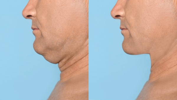Which Non-Surgical Treatments Work Best for Jowls and Loose Skin East Kilbride?