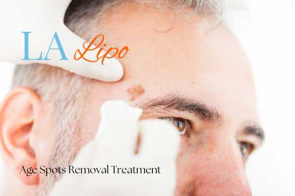 What Are the Most Effective Treatments for Age Spots East Kilbride?