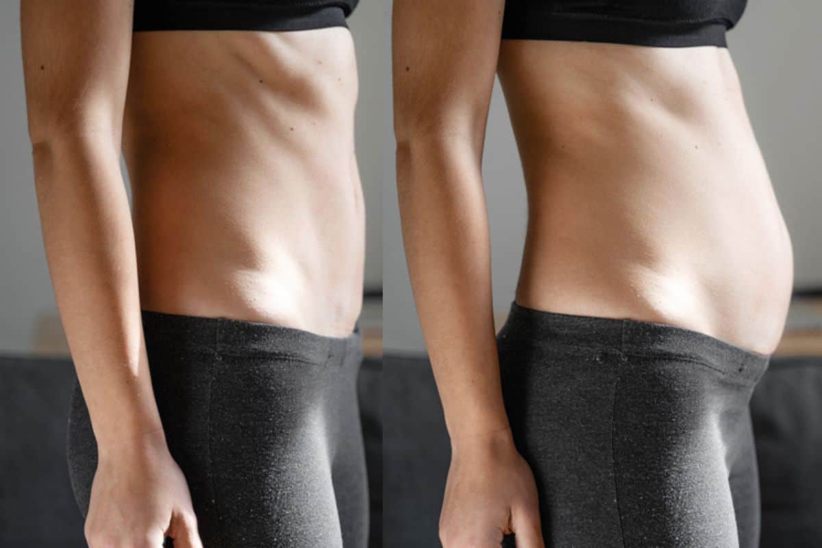How long does diastasis recti take to improve East Kilbride?