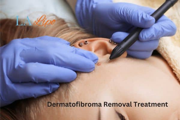 Dermatofibroma Removal Treatment East Kilbride