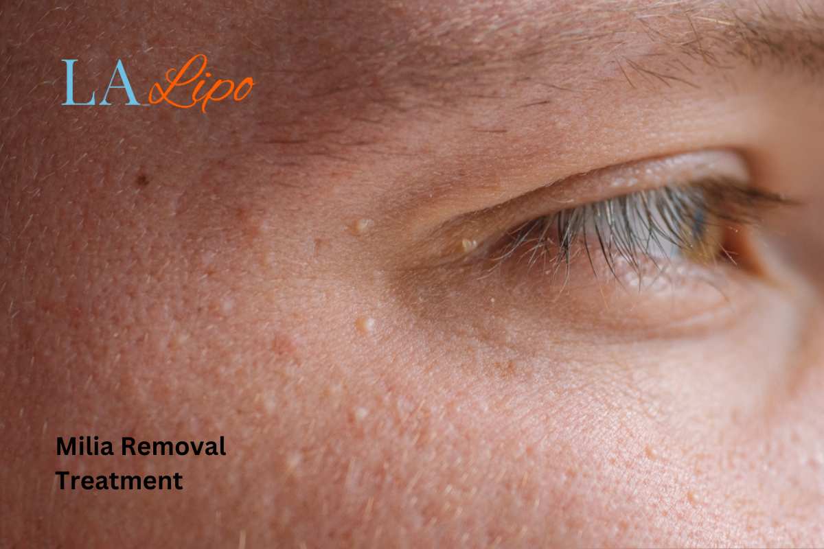 Cryopen Milia Removal: Is It the Easiest and Safest Option East Kilbride?