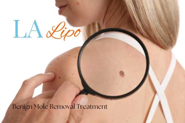 Woman having her inspection of blemish before mole removal East Kilbride