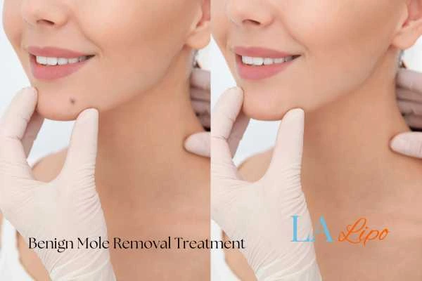 Before and after mole removal East Kilbride treatment