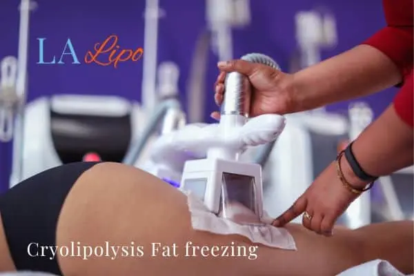 women getting fat freezing East Kilbride