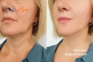 hi-fu for wrinkles East Kilbride before and after results