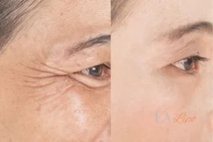 Before and after results of woman - HI-fu wrinkles reduction treatment East Kilbride