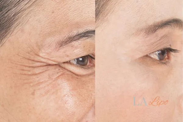 Before and after results of woman - HI-fu wrinkles reduction treatment East Kilbride