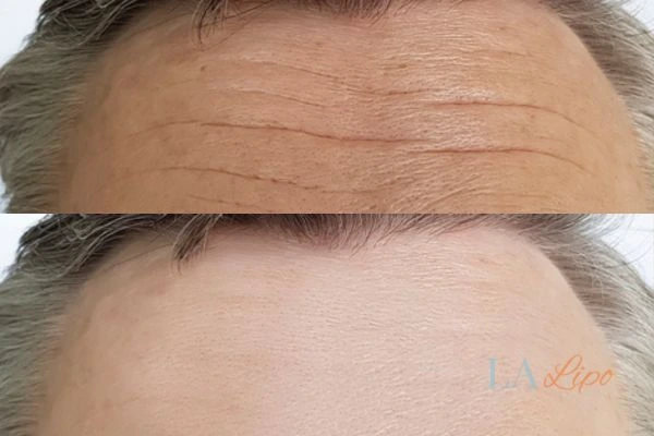 results of HIFU East Kilbride on mans forehead to help reduce lines and wrinkles