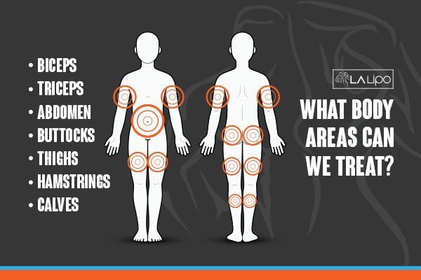 Graphic to show areas you can have LA-EMS Body Sculpting East Kilbride treatment.
