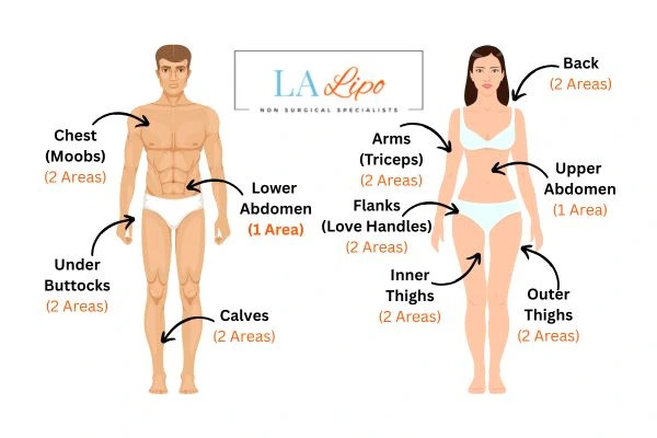 LA LIPO Cryolipolysis Areas East Kilbride