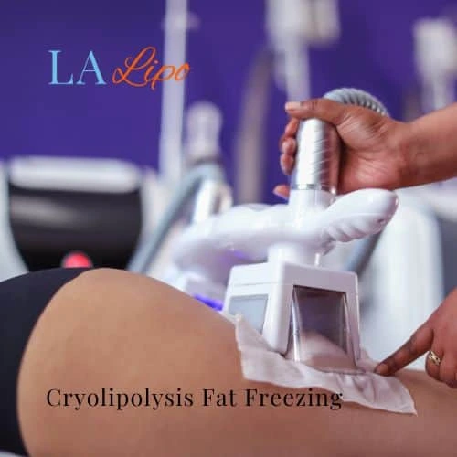 fat freezing - Cryolipolysis East Kilbride