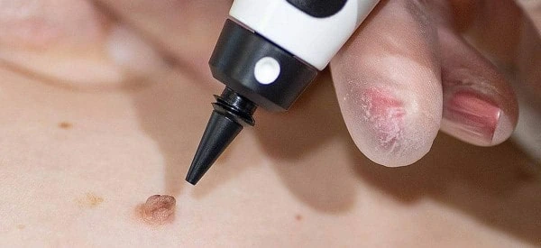 skin tag removal using cryopen East Kilbride
