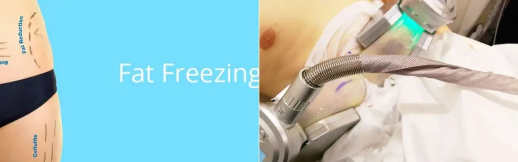 Fat freezing East Kilbride on multiple areas of the body