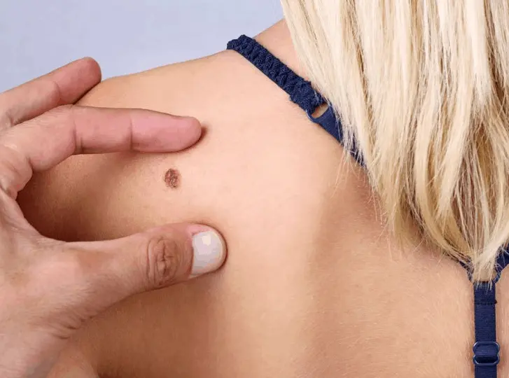 woman having mole removal East Kilbride consultation before treatment.