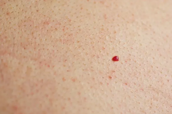 close up of a cherry angioma East Kilbride