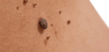 image of a skin tag East Kilbride