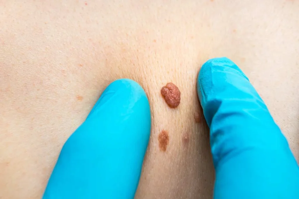 Consultant examining a skin tag East Kilbride