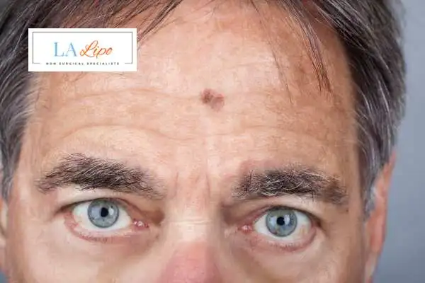 Solar Lentigo Removal East Kilbride image of man with mark on his forehead