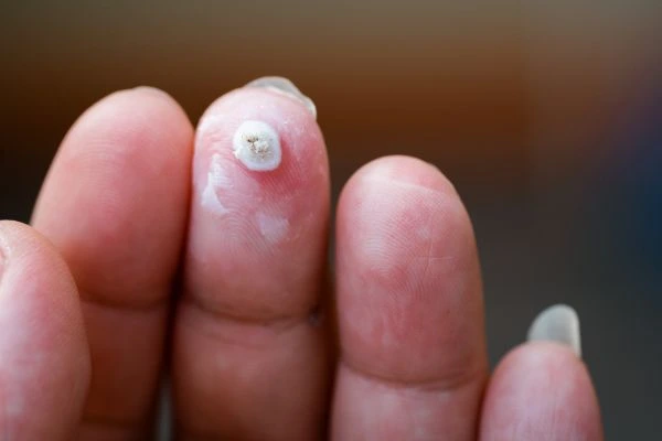wart on person finger - cryotherapy to treat from LA LIPO East Kilbride