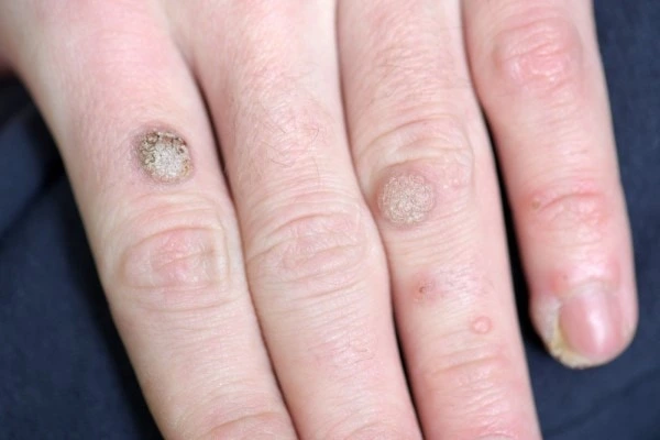 photo of warts on person hand - see wart removal East Kilbride from LA LIPO