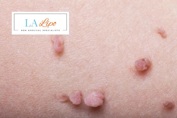 Does cryopen skin tag removal East Kilbride hurt? Find out now call our team today!