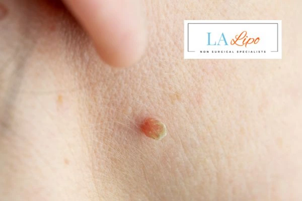 Book skin tag removal East Kilbride today speak to our team now!