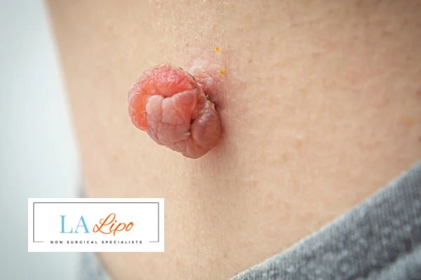 Interested in skin tag removal East Kilbride? Concerned about the pain? Find out more today!