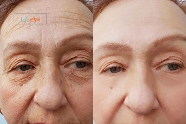 The powerful benefits of Morpheus8 Treatment East Kilbride - Call Our team today!