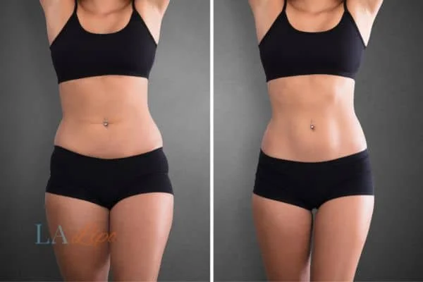 before and after results of non-surgical treatment to help a woman's body image and mental health East Kilbride