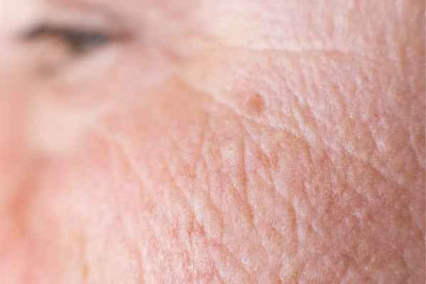 close up picture of a woman's face showing an age spot East Kilbride