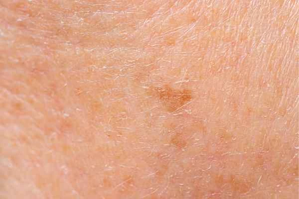 close up picture of age spots East Kilbride