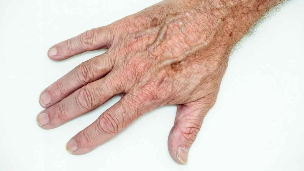 Male hand showing age spot East Kilbride