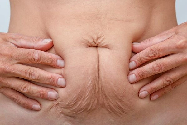 Image of a woman's stomach with loose skin - example of skin tightening East Kilbride options