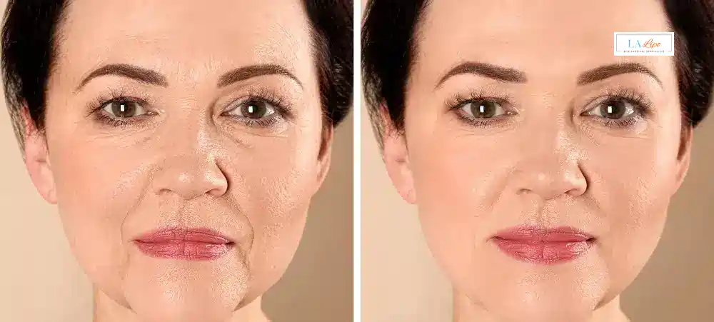 How Long Does It Take to See Results and How Long Do They Last East Kilbride?