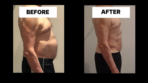 What Symptoms Can Diastasis Recti Cause in Men? Weak Core, Back Pain and Poor Posture East Kilbride